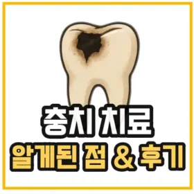 충치치료 후기 및 알게 된 점 섬네일